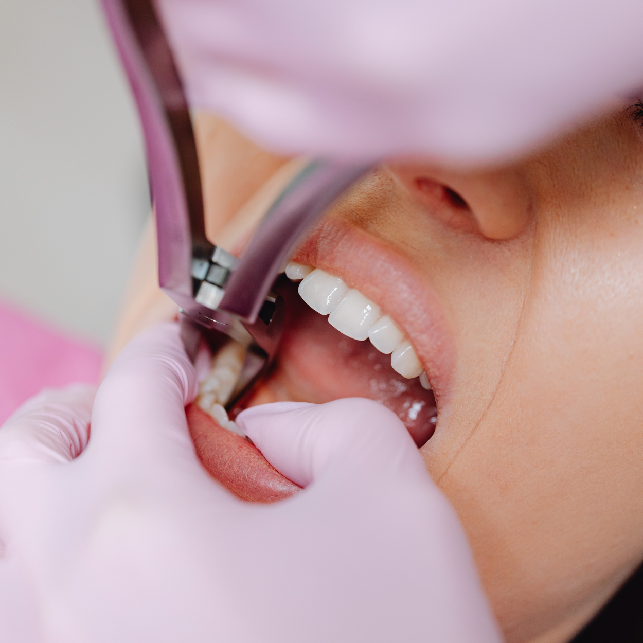Extractions Courtenay, BC VN P